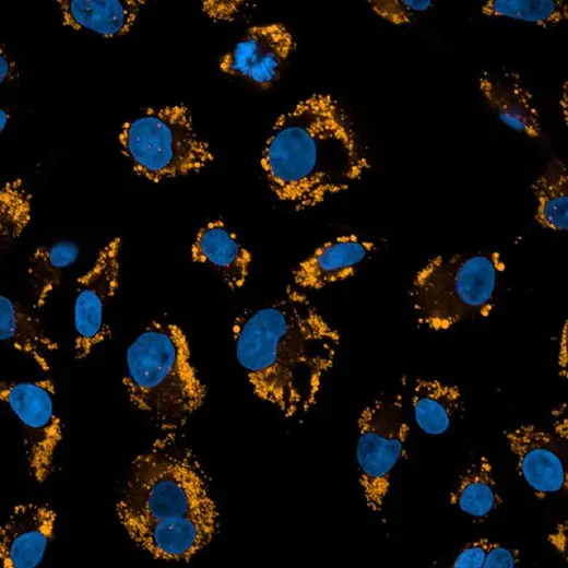 HepG2 cells treated with Oleic Acid-BSA then fixed (PFA) and stained with PhenoVue Nile-Red Lipid Stain (Lipid Droplets, orange) + PhenoVue Hoechst 33342 Nuclear Stain (nucleus, blue). Imaged on Operetta CLS.