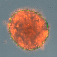  3D tumor spheroid high drug dose