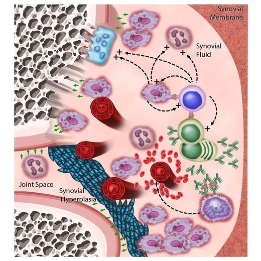 Arthritis Illustration