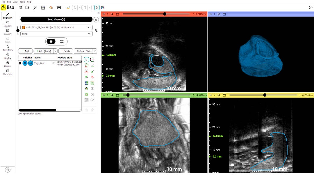 AI-assisted liver volume segmentation
