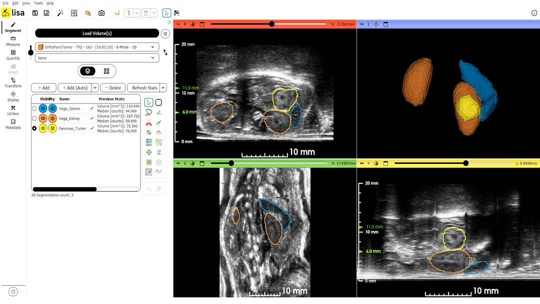 AI-assisted segmentation of pancreatic tumor and surrounding organs