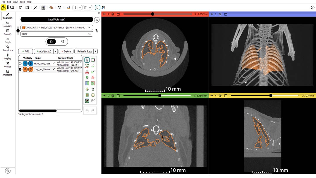 AI-powered segmentation of lung