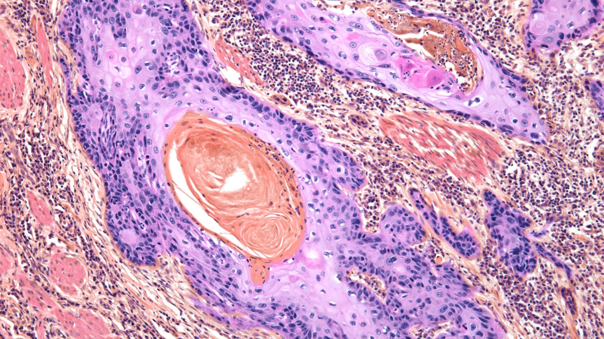 img-biomarker-in-cancer-1920x1080