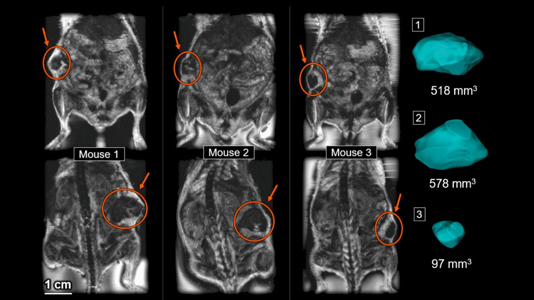Tumor volume
