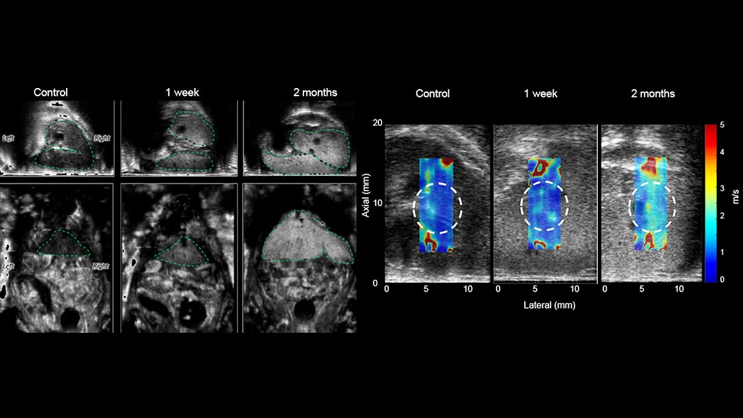 Evaluated liver stiffness using shear wave elastography