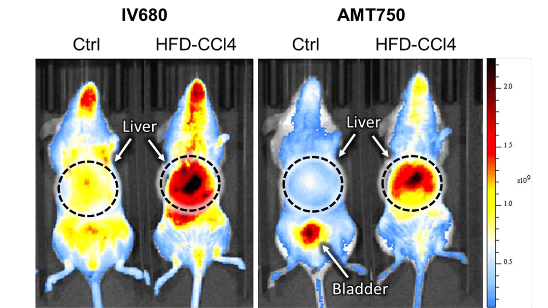 Evaluating liver inflammation