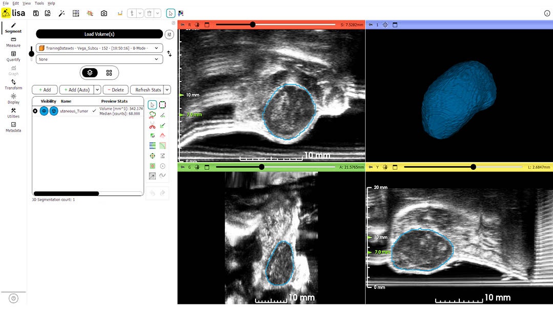Segmentation of breast tumor using AI-assisted analysis