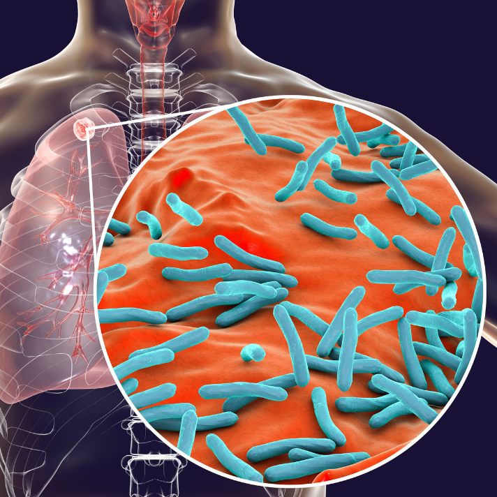 Tuberculosis info