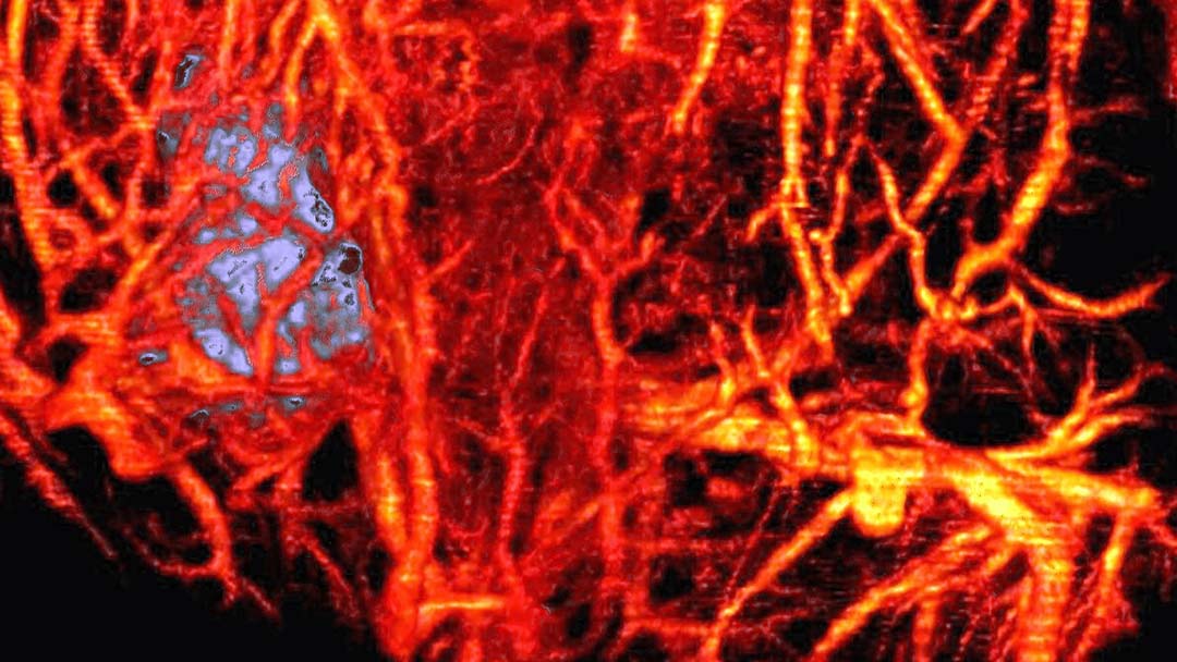 Acoustic angiography