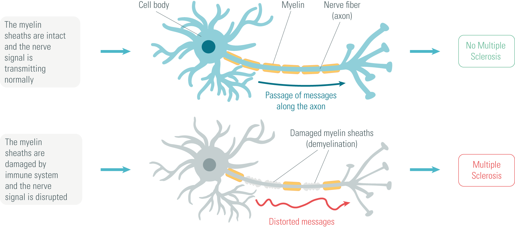 multibple-sclerosis-neurons